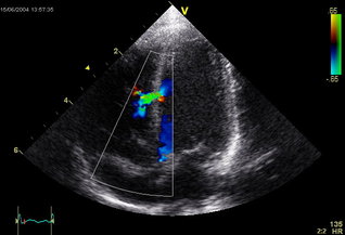 Abnormal results on a stress echocardiogram in HIV patients with known or suspected heart disease predict dramatically higher risk of heart attack or cardiac death. (Image courtesy: Wikipedia, taken by Kjetil Lenes)