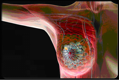 Early Treatment of Chest Lymph Nodes in Breast Cancer Improves Surviva