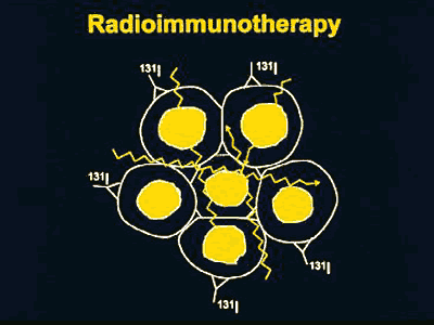 radioimmunotherapy is safe and effective